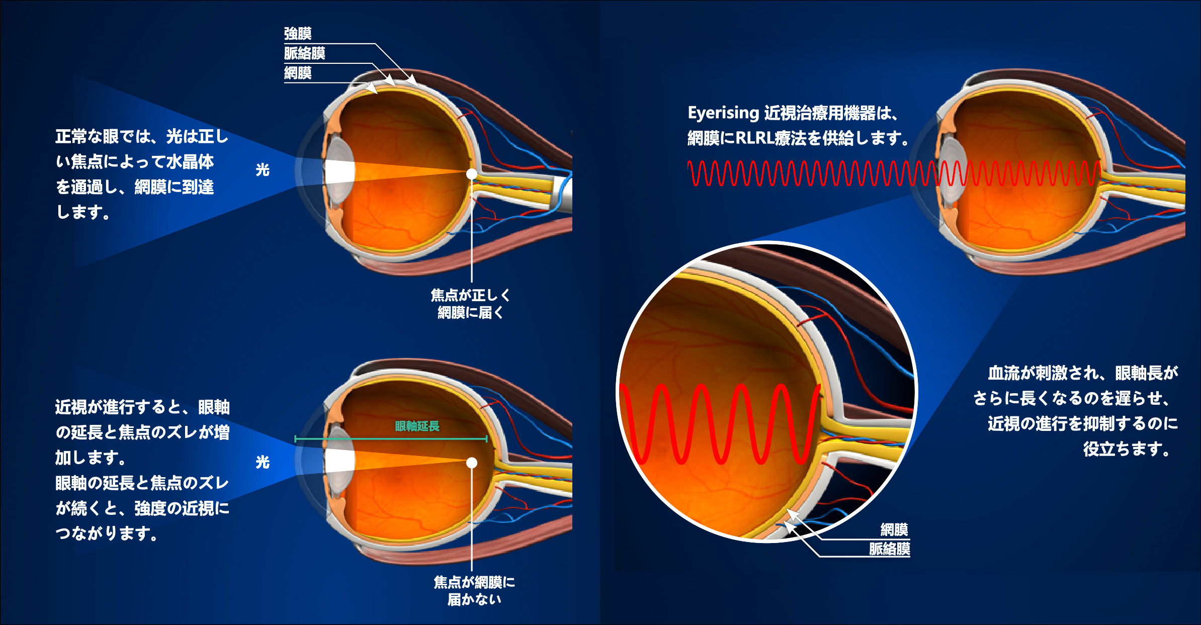 Eyerising（アイライジング）によるレッドライト治療法が機能する仕組みの説明画像