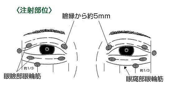 眼瞼痙攣の特徴