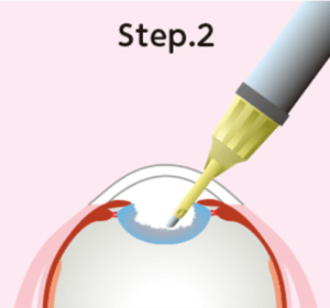 通常の白内障手術の流れ Step.2