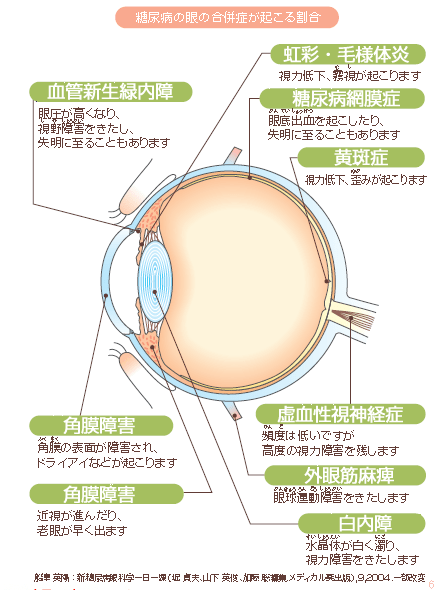 糖尿病の眼合併症