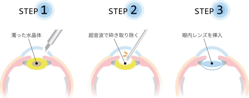 白内障手術の手順